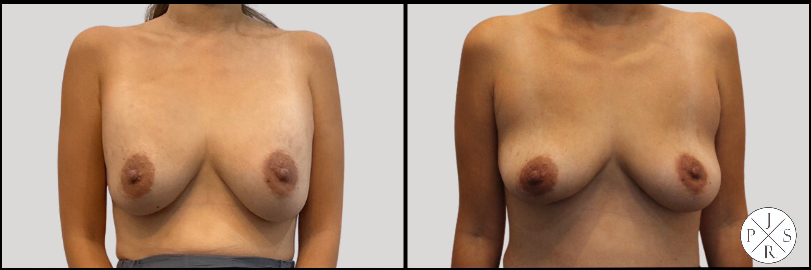 Breast Implant Removal Before & After Image